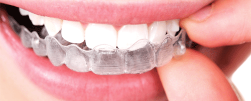 ortodoncia estética con invisalign