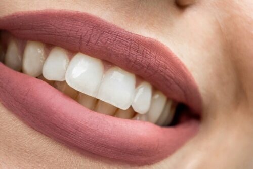 blanqueamiento dental o diseno de sonrisas