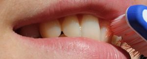 Hipersensibilidad dental
