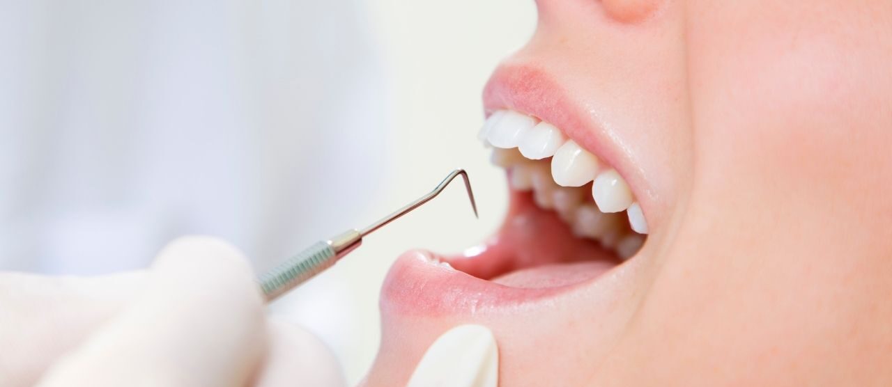 Cómo quitar el sarro de los dientes sin dañar el esmalte