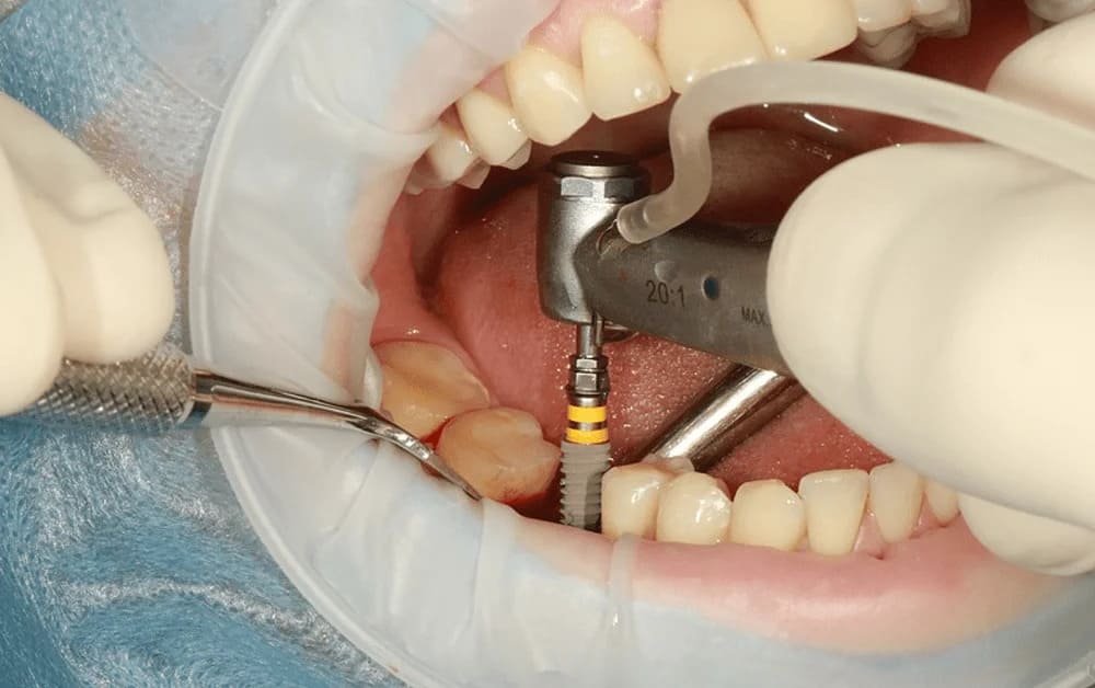 se puede poner implantes con periodontitis