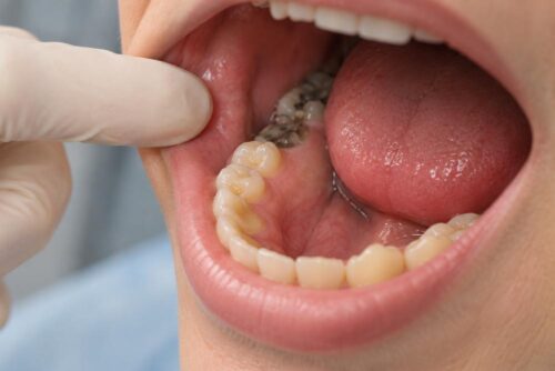 cuanto tarda una caries en destruir el diente