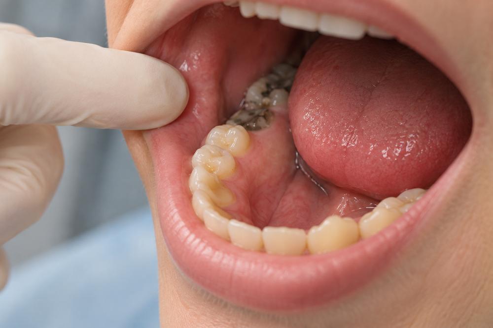cuanto tarda una caries en destruir el diente
