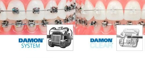 Ortodoncia Rápida Sistema Damon