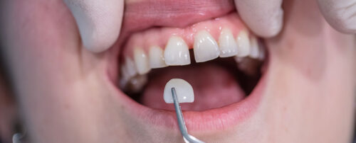 huecos entre los dientes