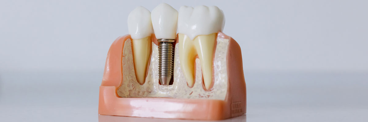 Implantes dentales All on 6