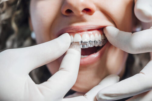 llevar ortodoncia con implantes dentales