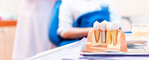 implantes dentales duelen