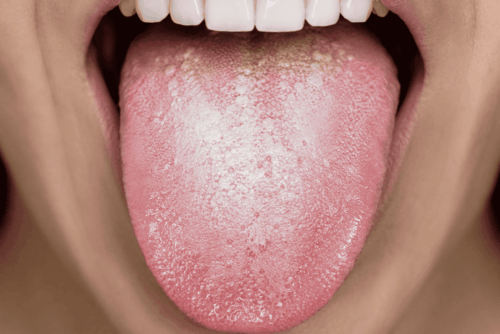 manchas blancas en la lengua por estres