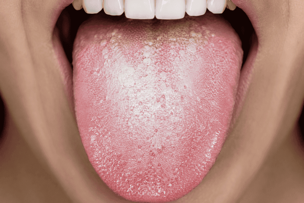manchas blancas en la lengua por estres