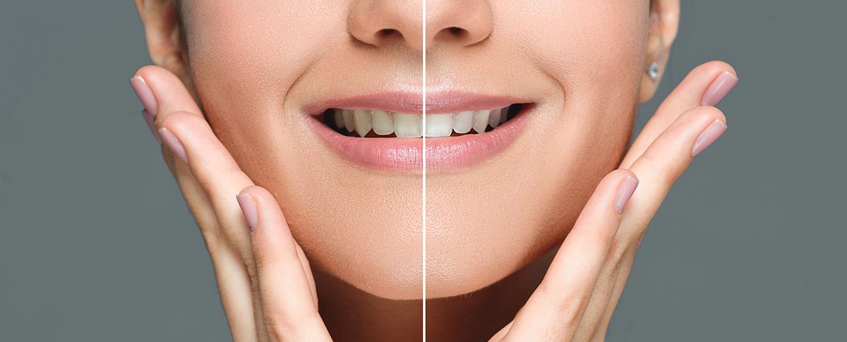 beneficios del blanqueamiento dental