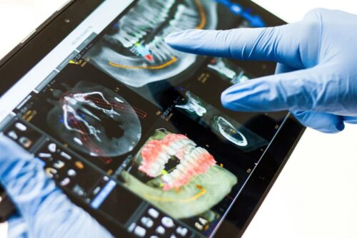 se pueden poner implantes con poco hueso