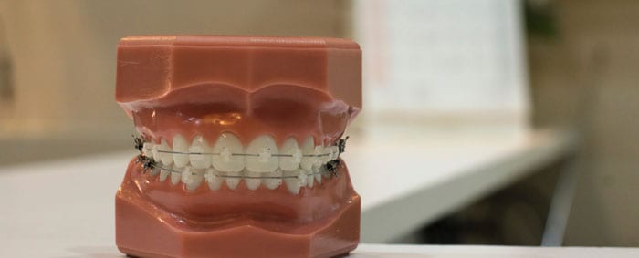 limpiar la ortodoncia